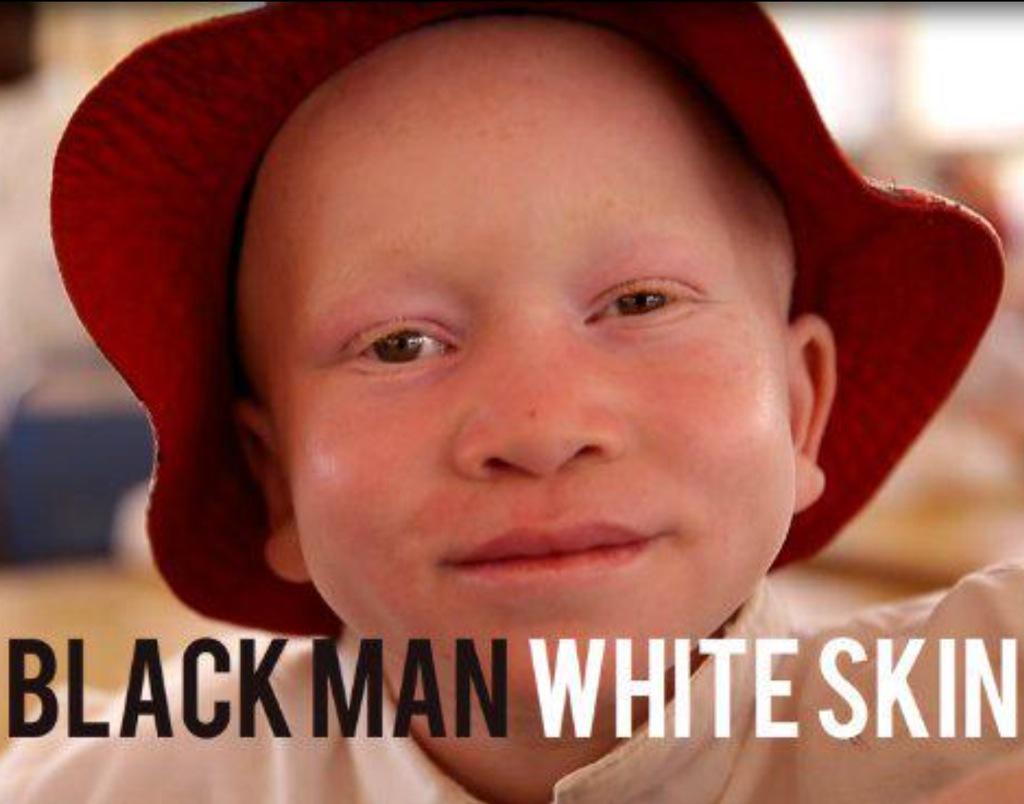 RarasNoInvisibles (@noinvisibles) on Twitter photo Docu "Hombre negro, piel blanca"
De <a href="/MrJColon/">Jose Manuel Colón</a> sobre #albinismo en África
blackmanwhiteskin.com
Gr. <a href="/LluisMontoliu/">Lluis Montoliu</a> Docu "Hombre negro, piel blanca"
De <a href="/MrJColon/">Jose Manuel Colón</a> sobre #albinismo en África
blackmanwhiteskin.com
Gr. <a href="/LluisMontoliu/">Lluis Montoliu</a>