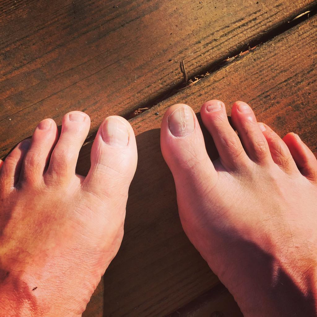 WMYrunners's tweet photo. Who has the gnarliest runners feet? Post pics here. We'll send a free #WhatMovesYou tee shirt to the ugliest pair. http://t.co/Fg2tEaAqBY