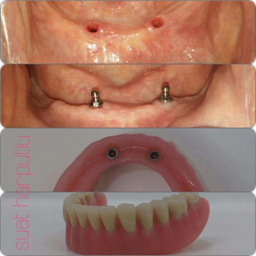 suatharputlu's tweet photo. #implant supported ball attachment systemfor edentolouspatient #dental #dentist #implantology #dentistry #oralsurgery http://t.co/fMpcYqzAl5