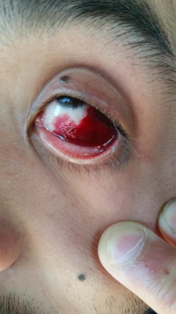tinbjj's tweet photo. Got my eyeball stepped on in my first match today #looksworsethanitis http://t.co/LwIvMs9U0S