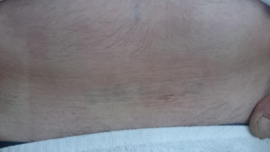 VintiqueRetford's tweet photo. Lower abdomen, bye bye tattoo. #tattooremoval #goodbyeink #Tickhill http://t.co/JxHvSLnwRt