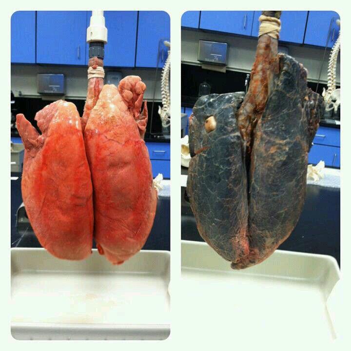 cateterdoblej's tweet photo. Es bueno recordar la comparación de los pulmones de un fumador vs. los de un no fumador #DiaMundialSinTabaco http://t.co/AUGAqChIEg