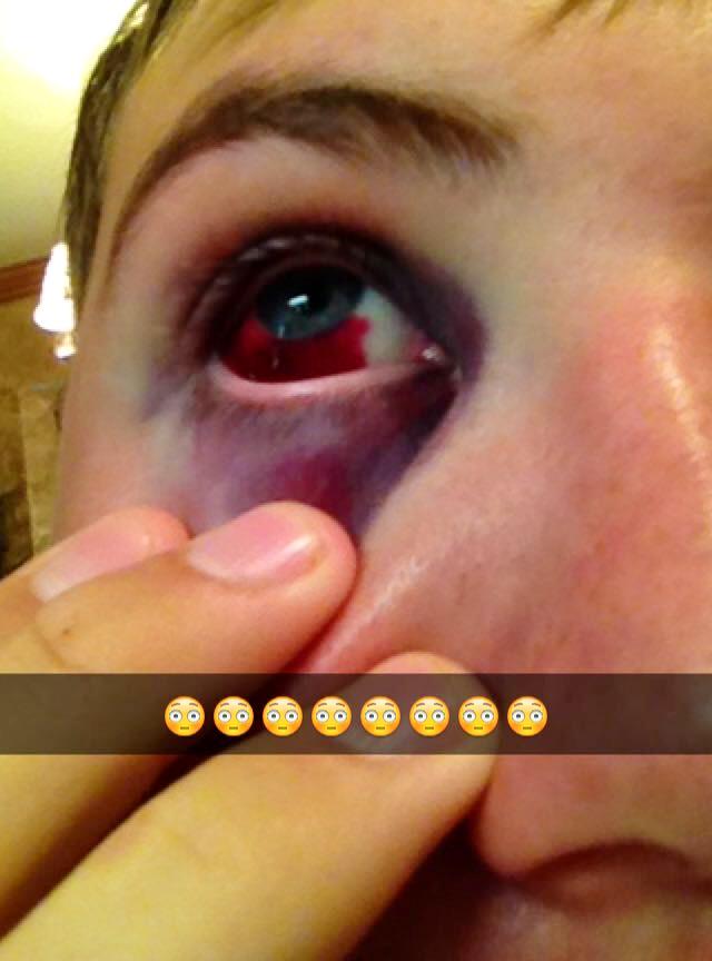 J_Tho17's tweet photo. Out for 6 weeks? Nah. More like 3😏 #faceofachamp http://t.co/BxeBis15C5