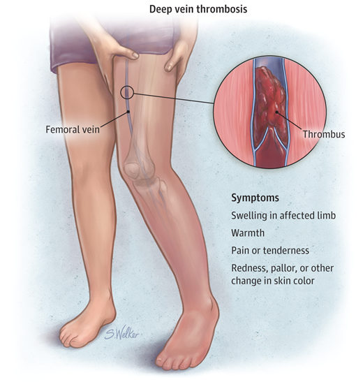 JAMA_current's tweet image. #JAMAPatientPage: Deep Vein Thrombosis ja.ma/1c5Ga0b #DVT