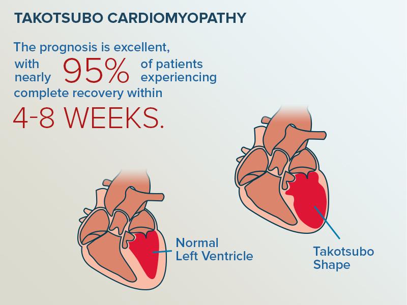 MedscapeStudent's tweet image. Counting down May's top trending search terms: At #5, it's Takotsubo Cardiomyopathy bit.ly/1HP1sum