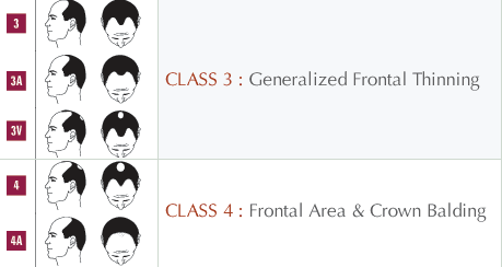 Norwood Hair Loss Chart