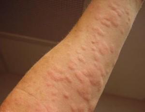 MedSymptoms's tweet image. Remedy for Hives - medicalsymptomsguide.com/remedy-for-hiv…