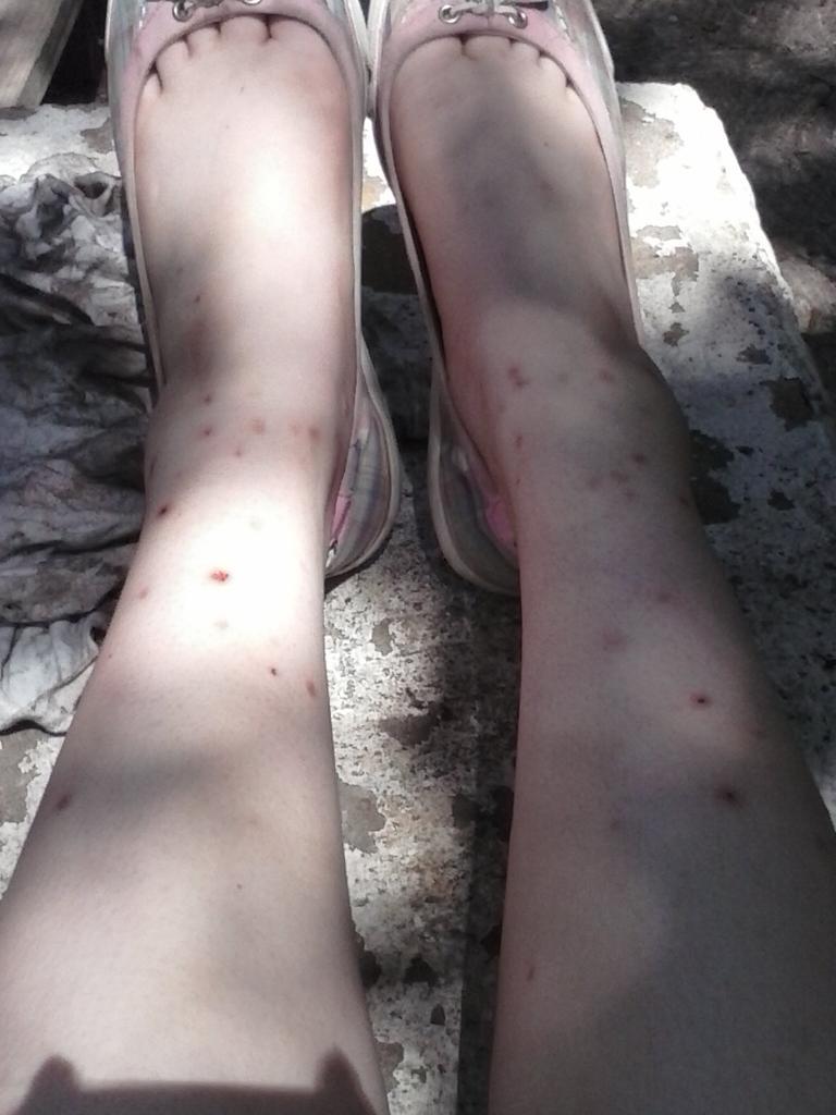 //slow replies. I'm looking up how to get rid of my chigger bites. If anyone has ways that might help plz et me know