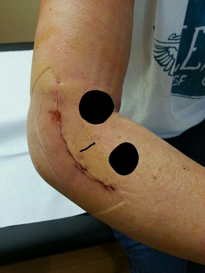 Jetzt ist Schluss mit sport 😕 Habe eine Trümmer Fraktur im Ellenbogen 😑