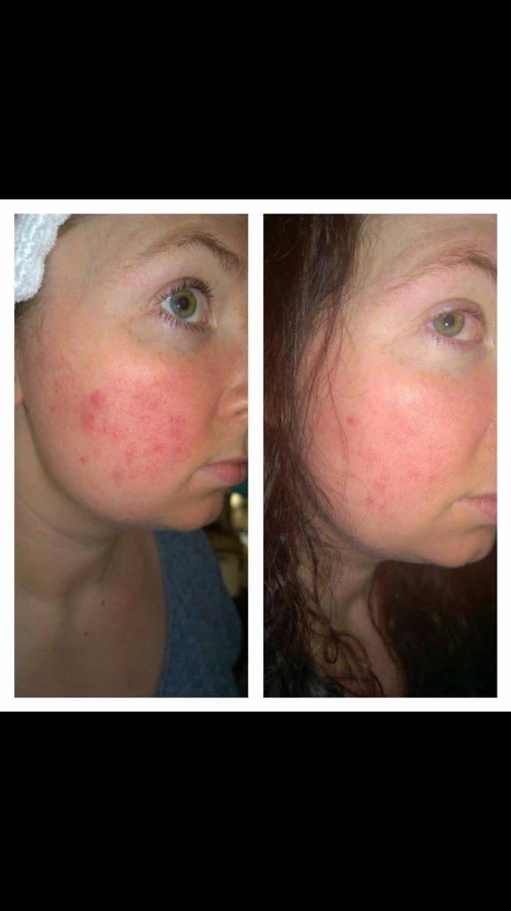 best tropic products for rosacea
