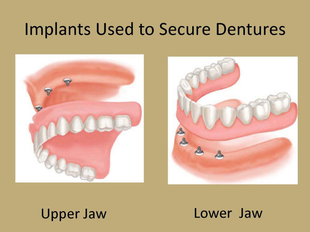 Strath_Dental's tweet photo. Via @PerioNews: traditional #dentures vs. #dentalimplants. #YEG #YEGDentists #dentureimplants: http://t.co/MoYJJ5xCbP http://t.co/gLMIGQYVDu