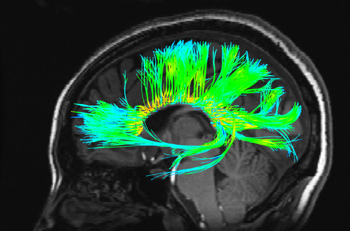 sciencebeta's tweet photo. Brain Imaging Predicts Psychotherapy Success In Social Anxiety Disorder http://t.co/JrIiB50Qdj http://t.co/61AI1XvrTZ