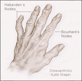 artroza zglobova foruma za liječenje ruku