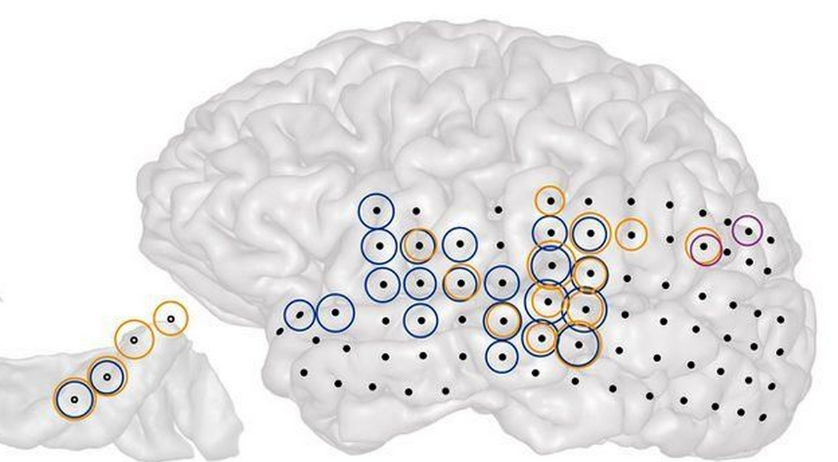 Tinnitus mapped inside human brain (BBC) : bbc.in/1AQ3R8I