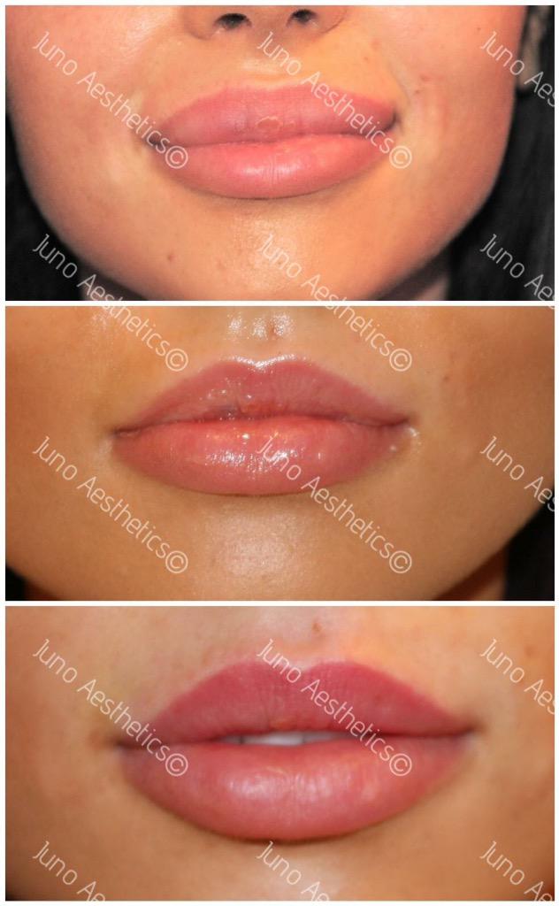 junoaesthetics's tweet photo. #lipcorrection to improve #texture #shape of the top lip. Great #natural result with #umajeunesse #velvet #aesthetics http://t.co/ke7vFix4Tj
