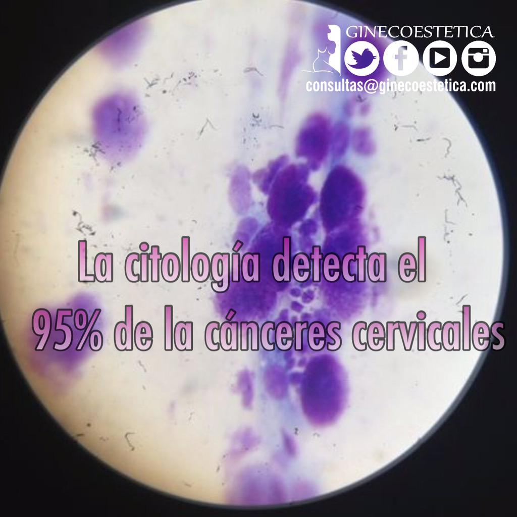 ginecoestetica's tweet image. La #citologia detecta el 95% de los cánceres cervicales #acudealginecologo #AcudeATuMedico