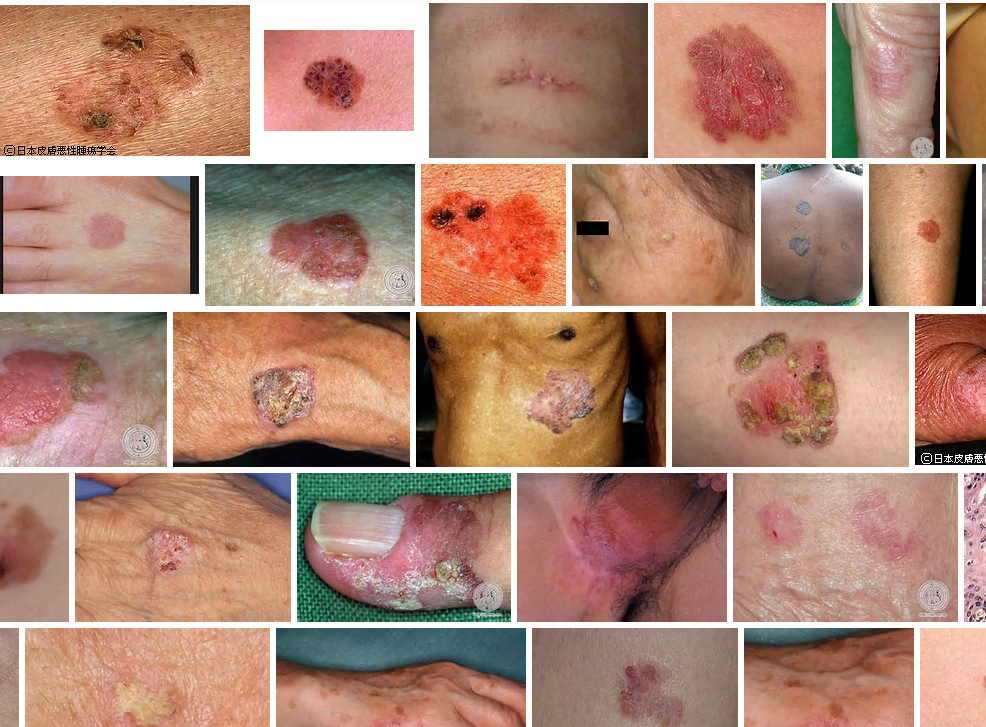 Cmk2wl ボーエン病 で Googleトレンド検索 日本 原因はヒ素中毒 日光照射 典型的には徐々に拡大する境界鮮明で不整型の紅斑が見られ 皮がめくれたり かさぶたを伴う とくに60歳以上の老人に発生する Http T Co Vadx0rswoj