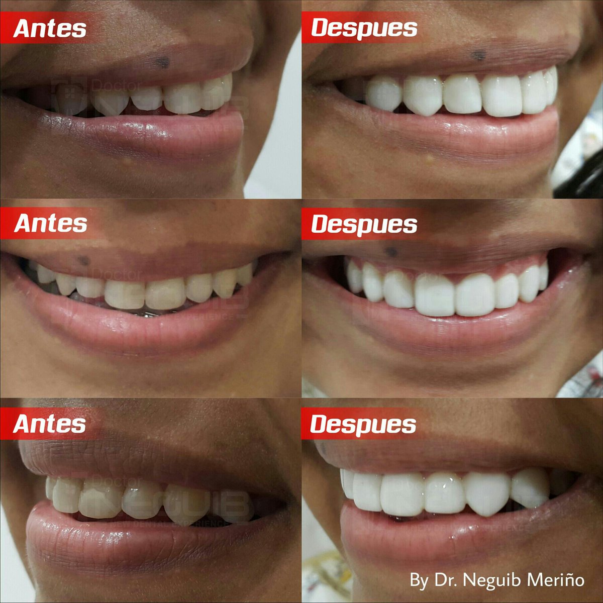 Diseno De Sonrisa En Ingles Citas Para Sexo En Vitoria