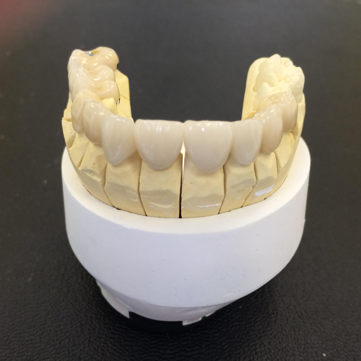 one of our latest jobs! #EmaxCrowns + #Veneers + #PorcelainBondedBridge