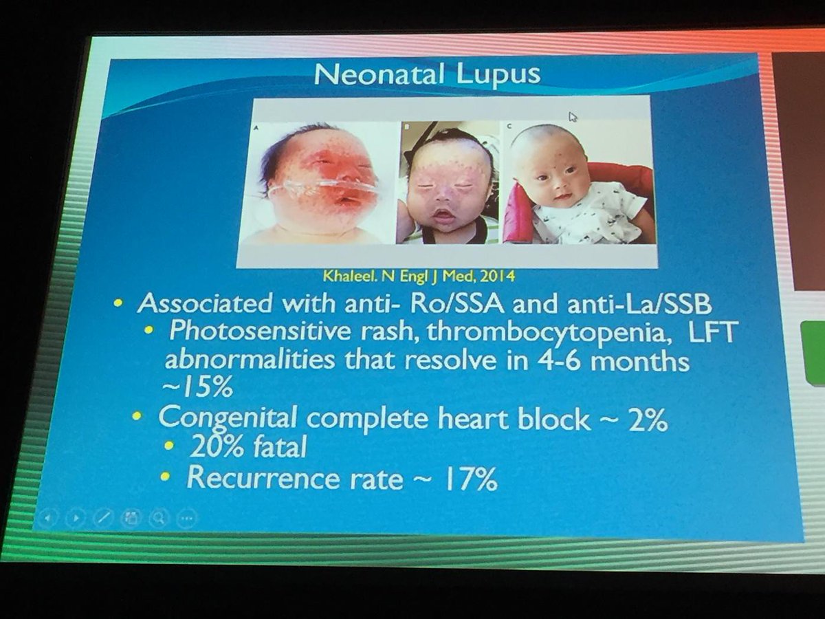 Dr Irwin Lim on Twitter "Neonatal lupus summary slide eular2015 http Dr Irwin Lim on Twitter "Neonatal lupus summary slide eular2015 http