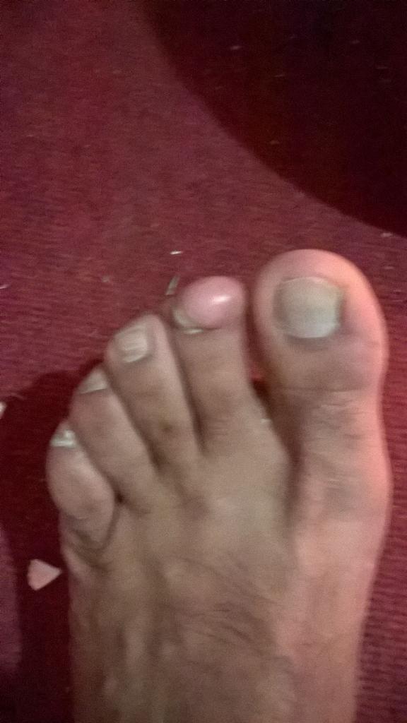 Ferroblack's tweet photo. Tengo el dedo asi hace un año me hice una radiografia y no es nada oseo http://t.co/CSkS4NQTxD
