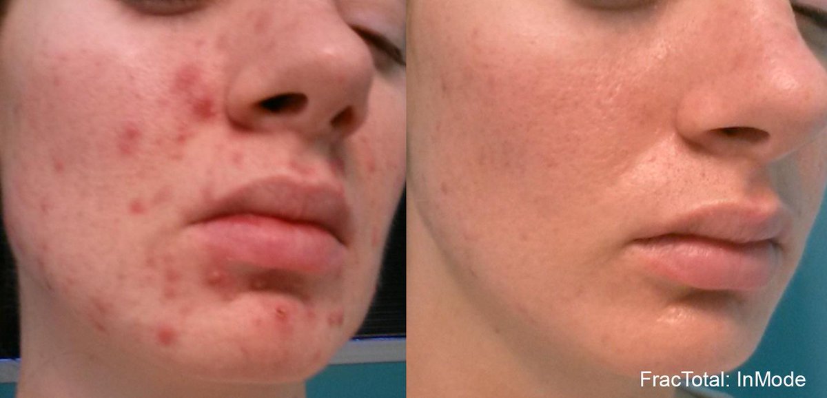 Invasix's tweet photo. SPOT the DIFFERENCE?
After 3 #Fractora + 1 #Lumecca #skin treatments. The results are #CLEAR!
#acne #pimples #scars http://t.co/JZSxpAZbXF