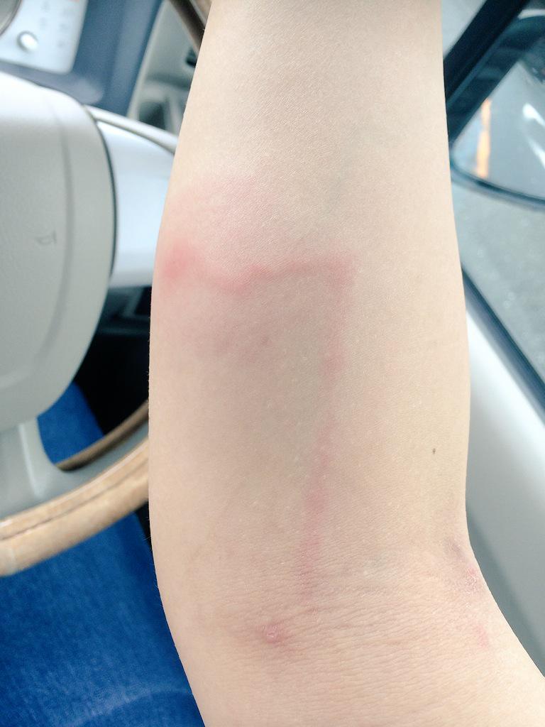 閲覧注意 甘く見てはならない 虫刺され リンパに沿って炎症 おかしいと思ったら 早めに病院へ Togetter 閲覧注意 甘く見てはならない 虫刺され リンパに沿って炎症 おかしいと思ったら 早めに病院へ Togetter