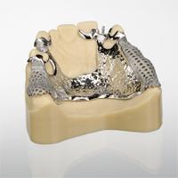 infiniDent's tweet photo. The future of partial frames: New #3Dprinted inDividual PF by @infiniDent. Laser-sintered removables from your CAD... http://t.co/hDKc8Ah3GL