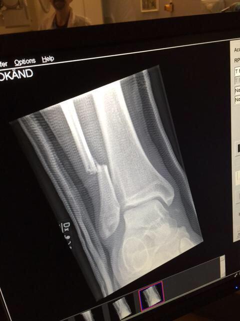 Dave Grohl is a god amongst men! What a trooper!