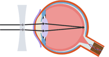 HaygroveScience's tweet photo. A concave lens helps short sightedness. #P3 http://t.co/fhMV5nrLYq