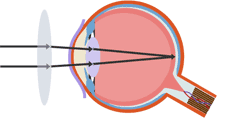 HaygroveScience's tweet photo. A convex lens corrects long sightedness.#P3 http://t.co/pDZFPA3ERX