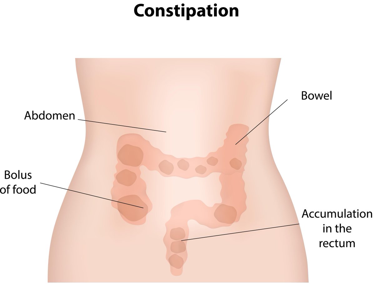 Wm Bowel Bladder On Twitter Chronic Constipation Damages The
