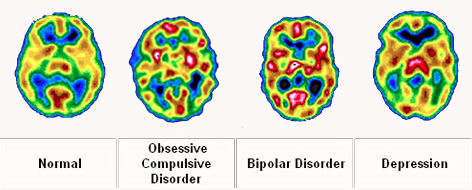 BMatterProject's tweet photo. Various #physiological #changes can be documented (via functional #MRI scans) for different #mentalillnesses http://t.co/8FjEFbeSEF