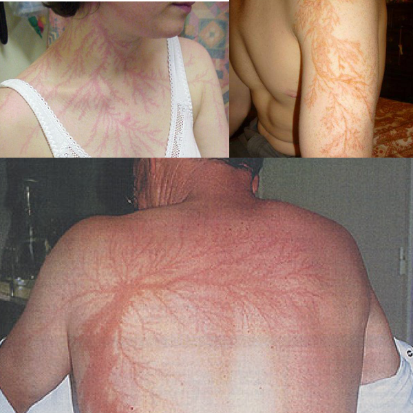 DMAX_es's tweet photo. Cuando un rayo alcanza la piel humana deja un tatuaje como este. Este efecto se llama figura de Lichtenberg. http://t.co/ESq9yIPlJE