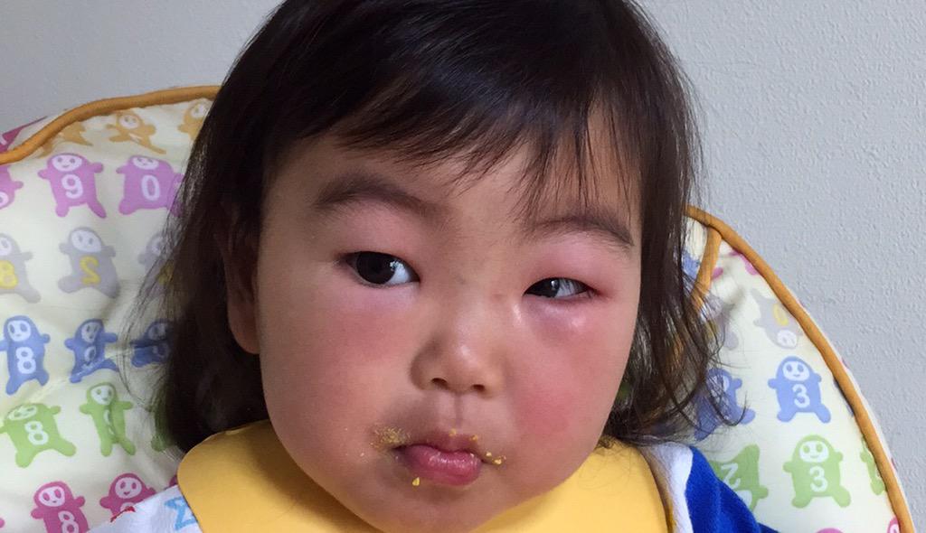 佐藤香織利 一昨日 娘が眼の側を蚊に刺されて顔が腫れ上がってしまった 皮膚科診察したところ眼の側は腫れやすい場所らしい しかしまるで別人 本来はくっきり二重でお目目ぱっちりなのに 皆さんも気をつけて Http T Co Db4g2iaiff Twitter 佐藤香織利 一昨日 娘が眼の側を蚊に刺されて顔が腫れ上がってしまった 皮膚科診察したところ眼の側は腫れやすい場所らしい しかしまるで別人 本来はくっきり二重でお目目ぱっちりなのに 皆さんも気をつけて Http T Co Db4g2iaiff Twitter