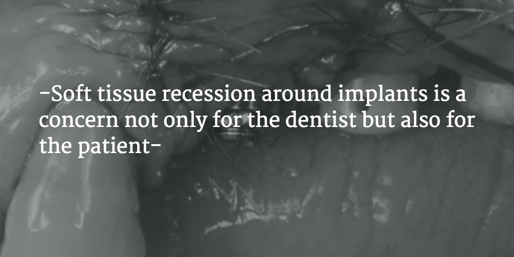 PerioSpot's tweet photo. How to solve a recession around implants? http://t.co/RXQ7b9KU0m #implantology @AmitPerioExpert http://t.co/401XA5Wtpy