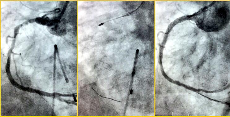 trivaxheartmd's tweet image. #rotablator #calcified #coronaryarterydisease #complex #highrisk #indicated #chips @bostonsci