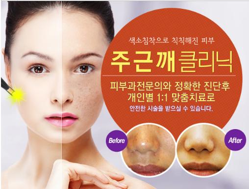 #리뉴미피부과 #주근깨제거 #레이저주근깨치료 여름의 자외선으로 인해 잘 생성되는 주근깨!고민이시라면 리뉴미피부과에서 레이저를 이용한 주근깨제거는 어떠세요? 자세히보기 > m.rnmeskin.com/clinic29/