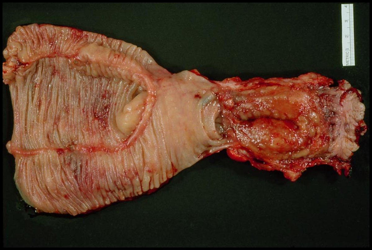 DDF2015 (@ddfconference15) on Twitter photo We need to avoid pouch rectostomy #DDF2015 - From <a href="/petesagar7/">Pete Sagar</a> We need to avoid pouch rectostomy #DDF2015 - From <a href="/petesagar7/">Pete Sagar</a>