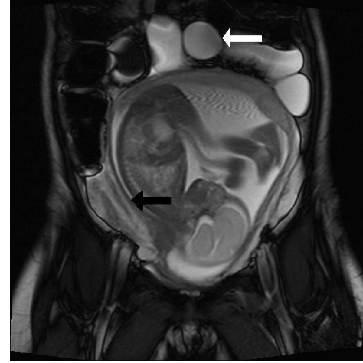 DDF2015 (@ddfconference15) on Twitter photo #DDF2015 Fertility seems to better with laparascopic surgery <a href="/JayneEaden/">Jayne Eaden</a> - from <a href="/petesagar7/">Pete Sagar</a> #DDF2015 Fertility seems to better with laparascopic surgery <a href="/JayneEaden/">Jayne Eaden</a> - from <a href="/petesagar7/">Pete Sagar</a>
