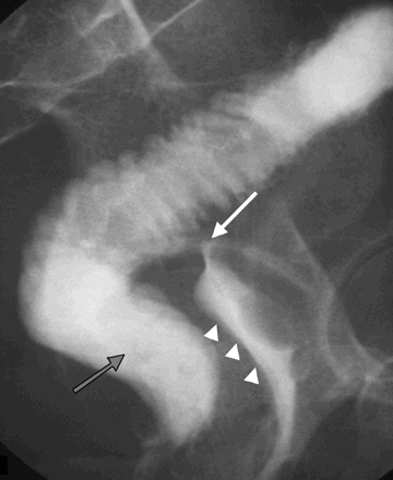 DDF2015 (@ddfconference15) on Twitter photo Pouch vaginal fistula - best treatment? #DDF2015 Pouch vaginal fistula - best treatment? #DDF2015