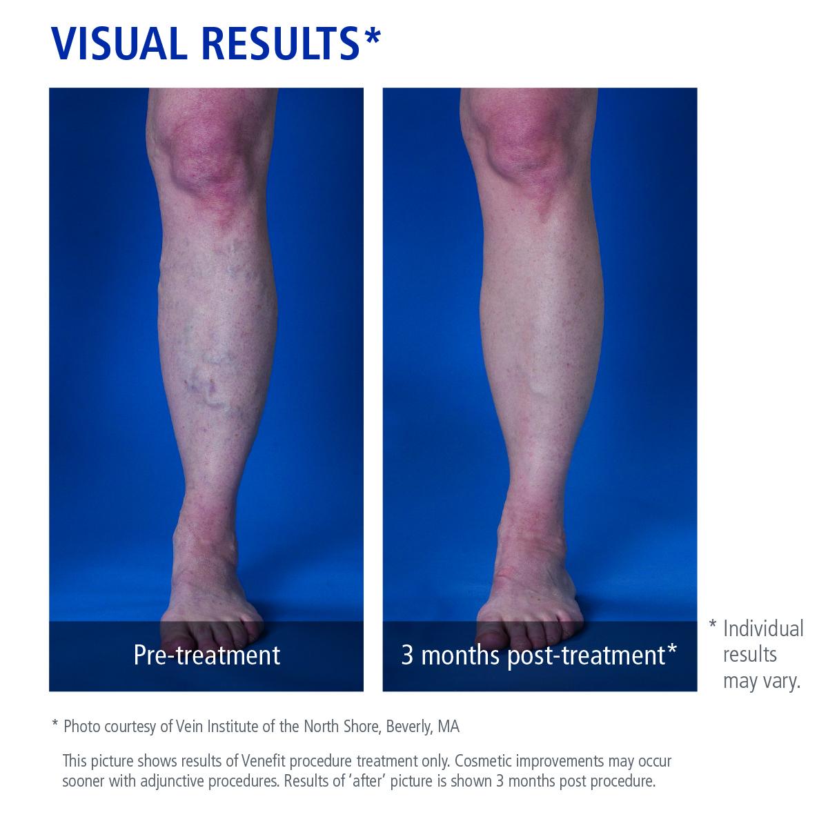 Embarrassed to show off your legs due to #varicoseveins? Call for a consultation: 305.822.0068 ow.ly/P2Y8D