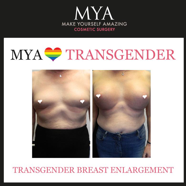 Transgender breast augmentation