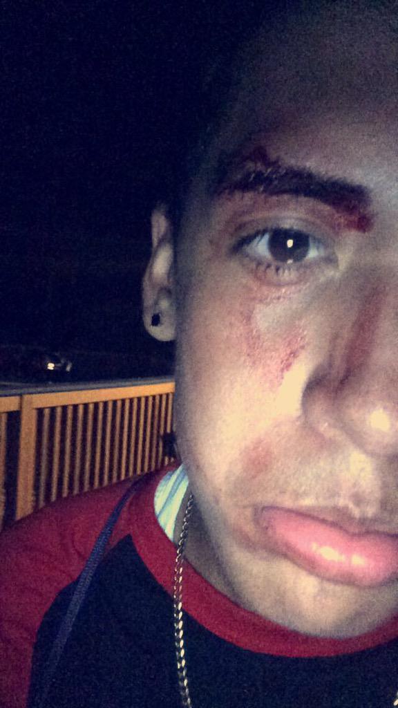 DjDiddyOfficial's tweet photo. #onetimeataparty I was stopping a fight & got hit w a crutch ๐๐ถ๐ http://t.co/27TsUZI1eq