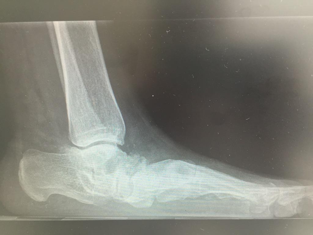 traumarioja's tweet photo. Pies planos en adulto.Observa el aplanamiento de la bóveda plantar. @trauma_modern @cateterdoblej @drcarlosrepetto http://t.co/qgcjUAUN62