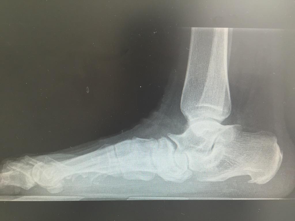 traumarioja's tweet photo. Pies planos en adulto.Observa el aplanamiento de la bóveda plantar. @trauma_modern @cateterdoblej @drcarlosrepetto http://t.co/qgcjUAUN62