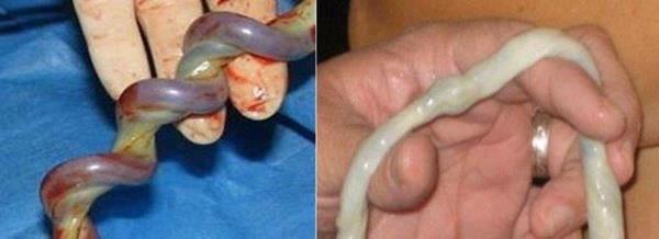 #pregnancy - "wait for white" takes the guesswork out of knowing when to clamp your baby's cord.  #gentlebirth