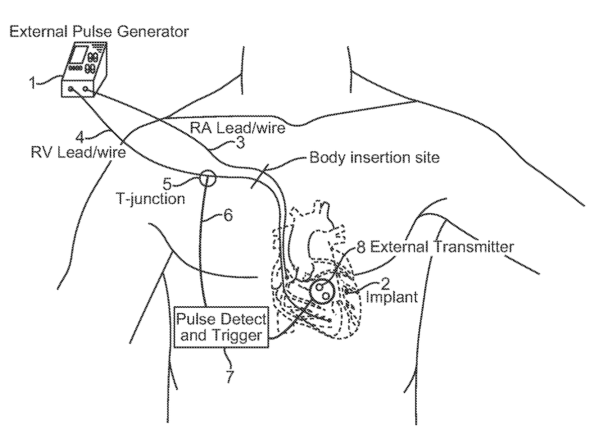 Transvenous Pacemaker Placement