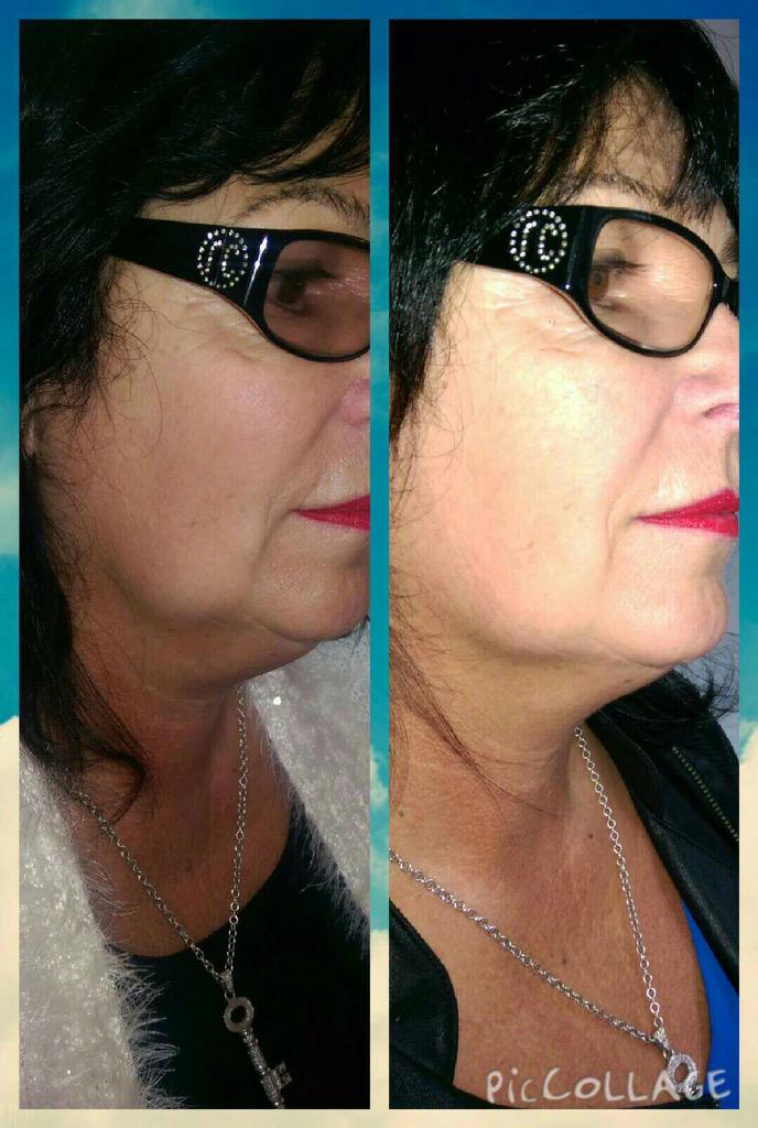 RT <a href="/btoxclinics/">Lee Walker</a>: Our fab <a href="/maureenbram/">Maureen Bramwell</a> post  <a href="/Aqualyx/">Aqualyx</a> dissolving injection. #10YearsYonger #firming #nojowls #jawline