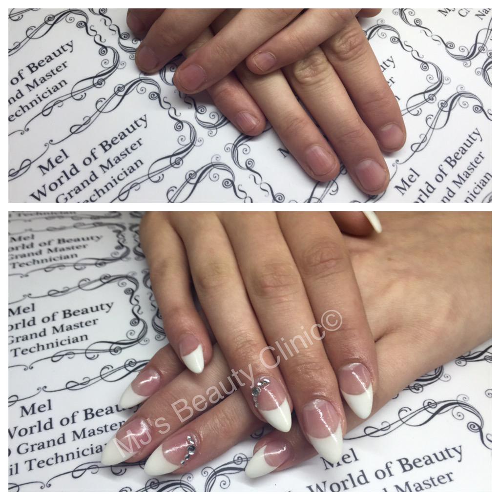MJsBeautyClinic's tweet photo. Nails Fit For a Ballπ
ππΈπΌ
Before & After, Nails for Prom
@ScratchMagazine @NSIUK @nailsmag #showscratch #classyfrench http://t.co/ULVmCjHUzh